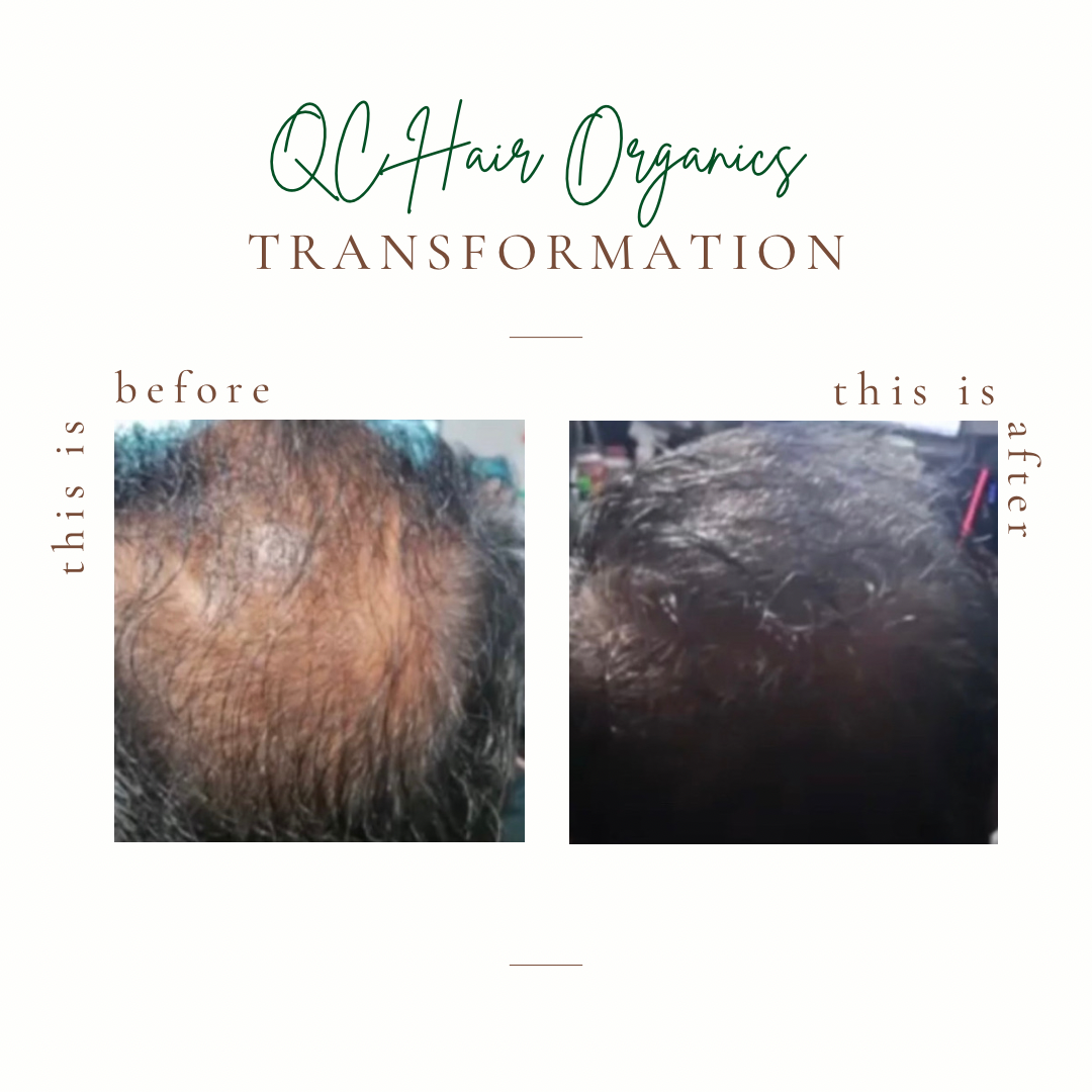 Ayurvedic Hair Growth Oil & Treatment
